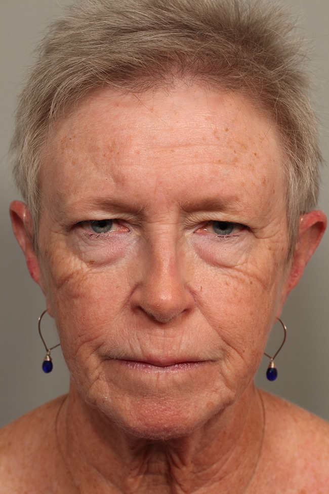 Before Image: Blepharoplasty, Eyelids, Browlift - front