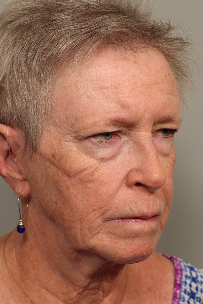 Before Image: Blepharoplasty, Eyelids, Browlift - right-front-oblique