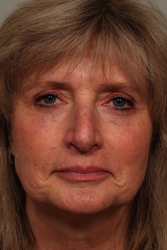 woman’s face after facial fat grafting procedure