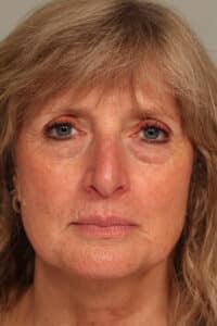 Fat Transfer, Lower Blepharoplasty