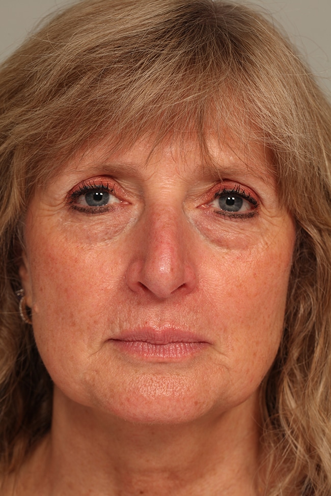 woman’s face before facial fat grafting procedure