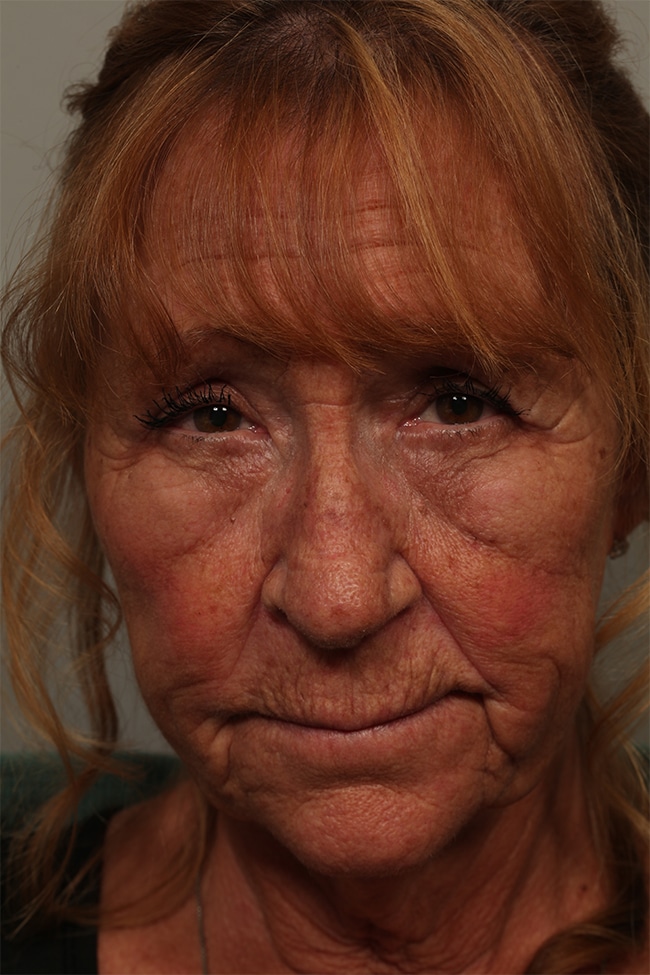 After Image: Upper Blepharoplasty, Direct Browlift, Temporal Hairline - front
