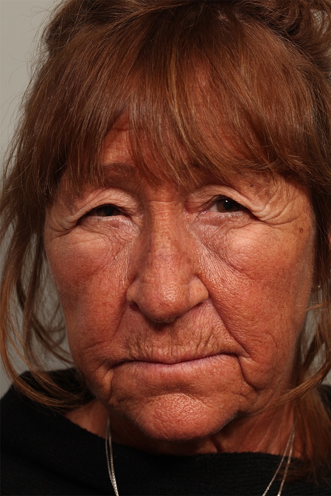 Before Image: Upper Blepharoplasty, Direct Browlift, Temporal Hairline - front