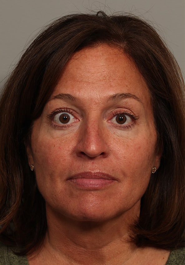 Before Image: Thyroid Eye Disease (Graves’) - front