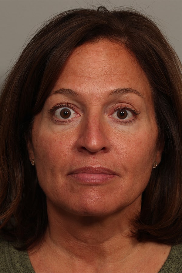 Before Image: Thyroid Eye Disease (Graves’) - front