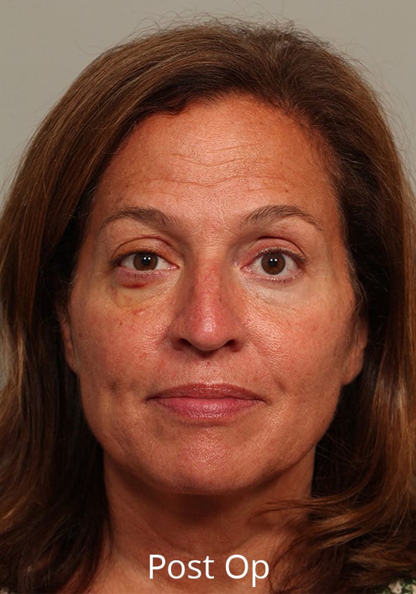 After Image: Thyroid Eye Disease (Graves’) - front