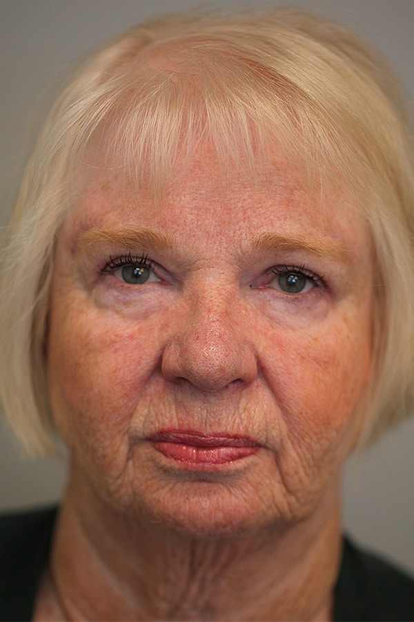 After Image: Upper Blepharoplasty and Direct Browlift - front