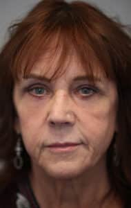 After Image: Upper and Lower Blepharoplasty with Full Face Laser Resurfacing
