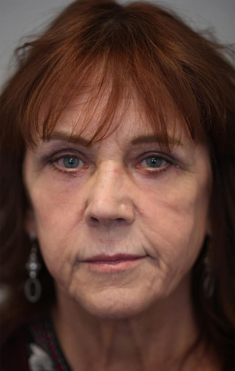 After Image: Upper and Lower Blepharoplasty with Full Face Laser Resurfacing - front