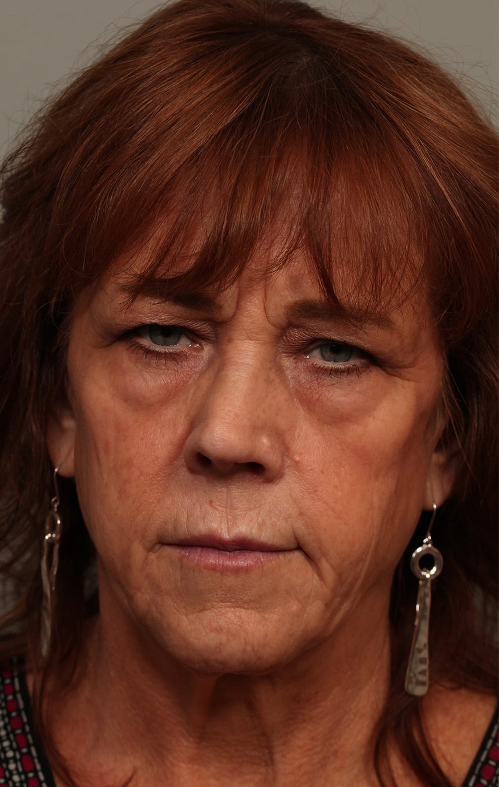 Before Image: Upper and Lower Blepharoplasty with Full Face Laser Resurfacing - front