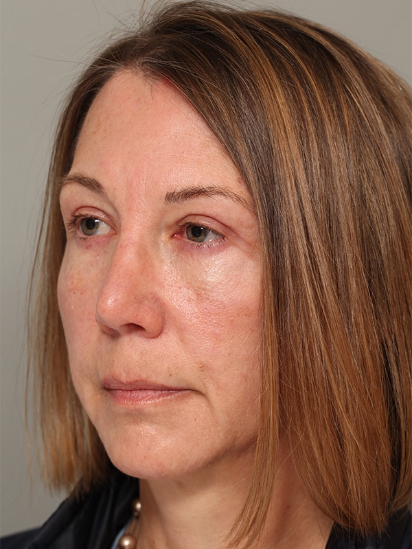 After Image: Upper Blepharoplasty, Browlift - left-front-oblique