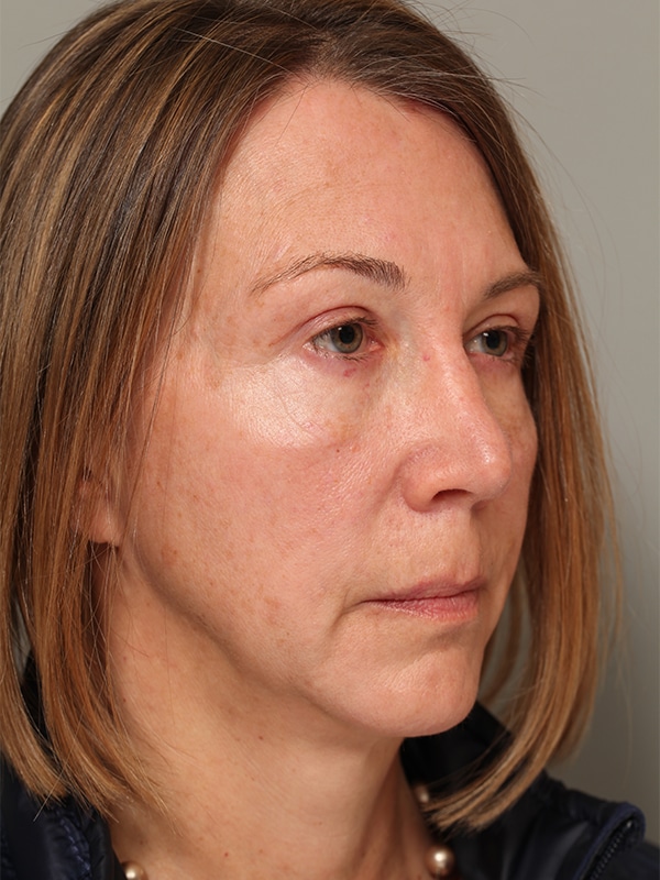 After Image: Upper Blepharoplasty, Browlift - right-front-oblique