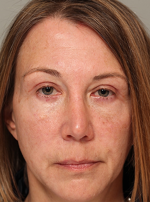 After Image: Upper Blepharoplasty, Browlift - front