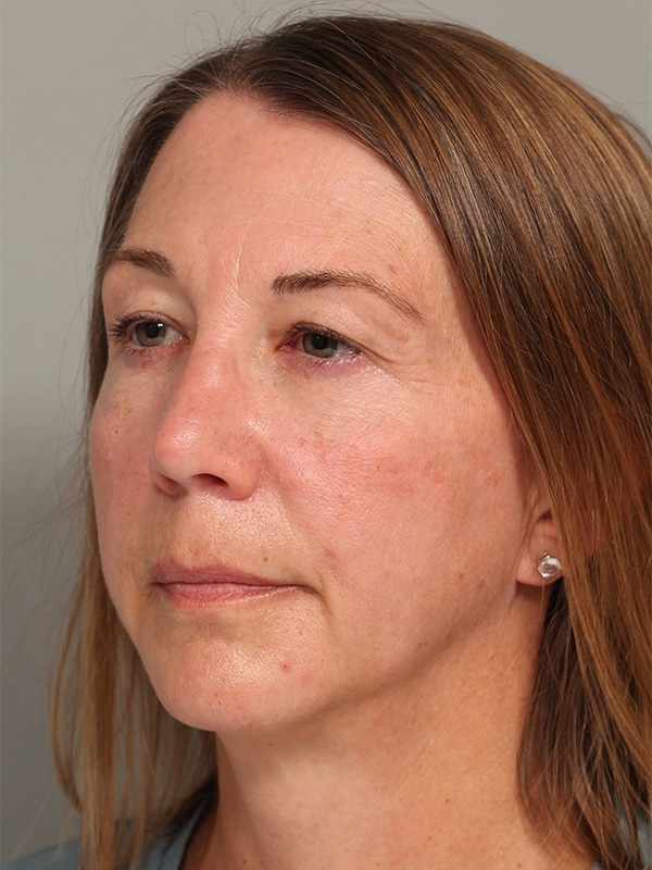 Before Image: Upper Blepharoplasty, Browlift - left-front-oblique