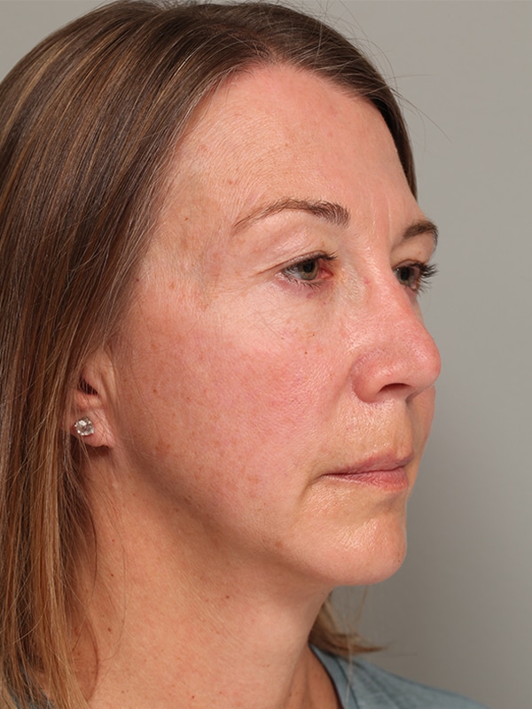 Before Image: Upper Blepharoplasty, Browlift - right-front-oblique