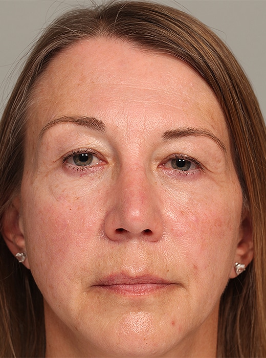 Before Image: Upper Blepharoplasty, Browlift - front
