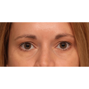After Image: Endoscopic Browlift