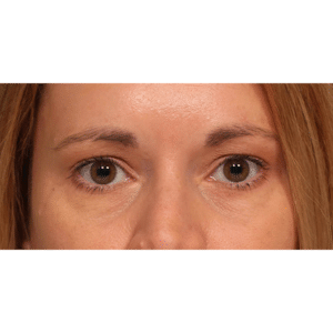 Endoscopic Browlift