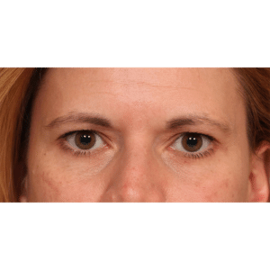 Before Image: Endoscopic Browlift