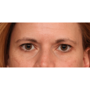 Endoscopic Browlift