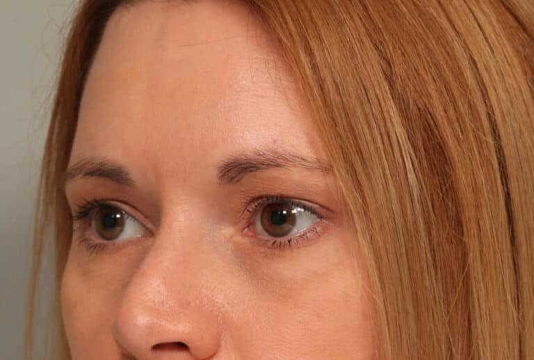 After Image: Endoscopic Browlift - left-front-oblique