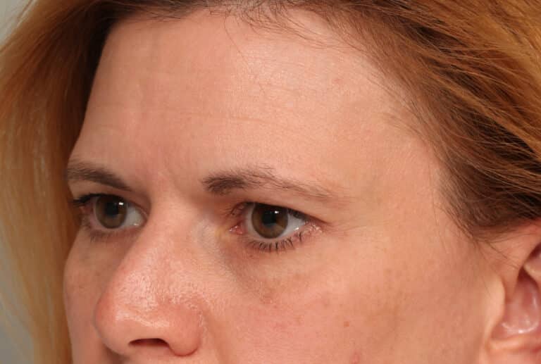 Before Image: Endoscopic Browlift - left-front-oblique