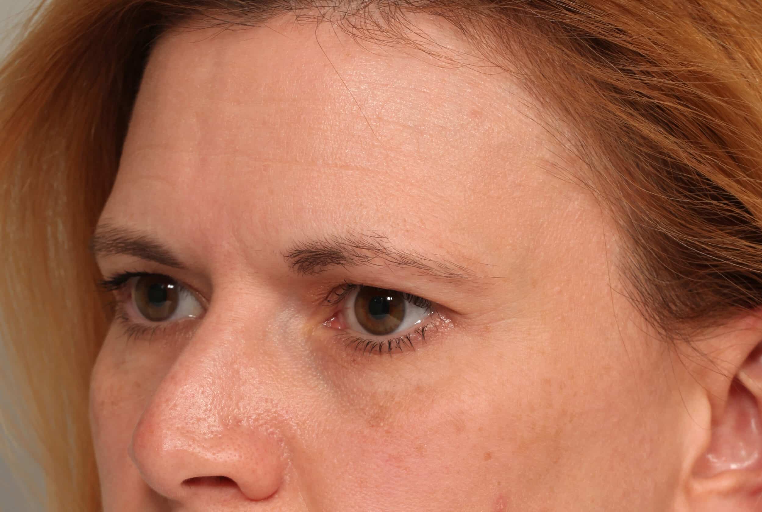 Before Image: Endoscopic Browlift - left-front-oblique
