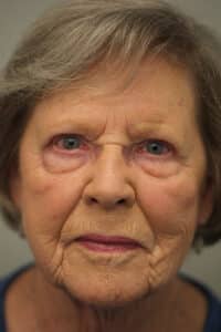 Upper Blepharoplasty