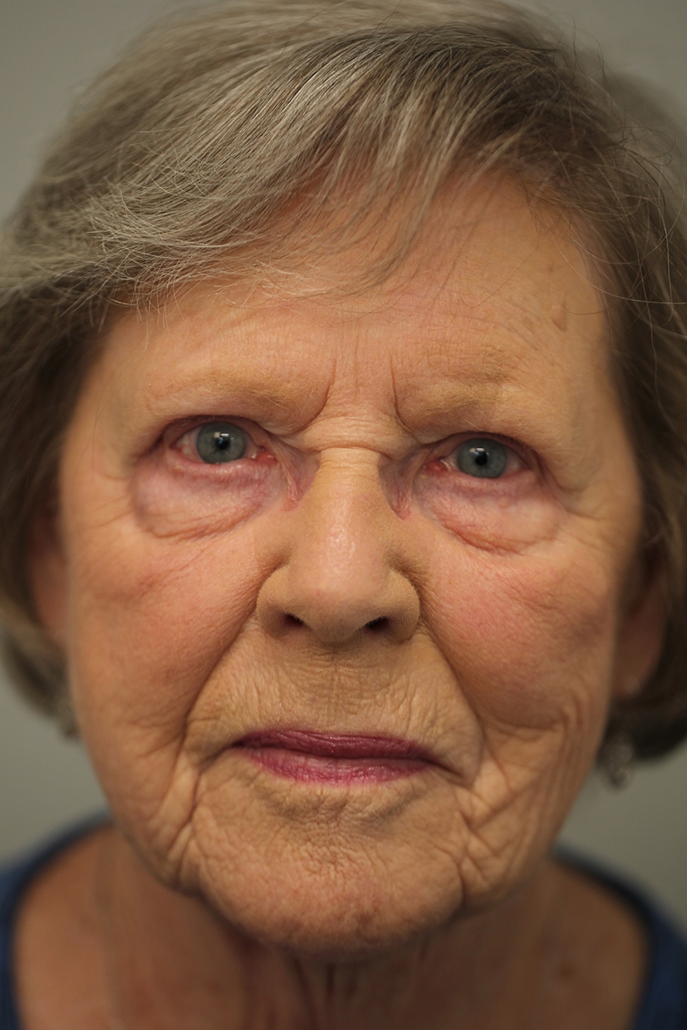 After Image: Upper Blepharoplasty - front