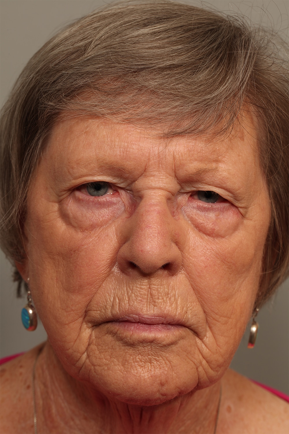 Before Image: Upper Blepharoplasty - front