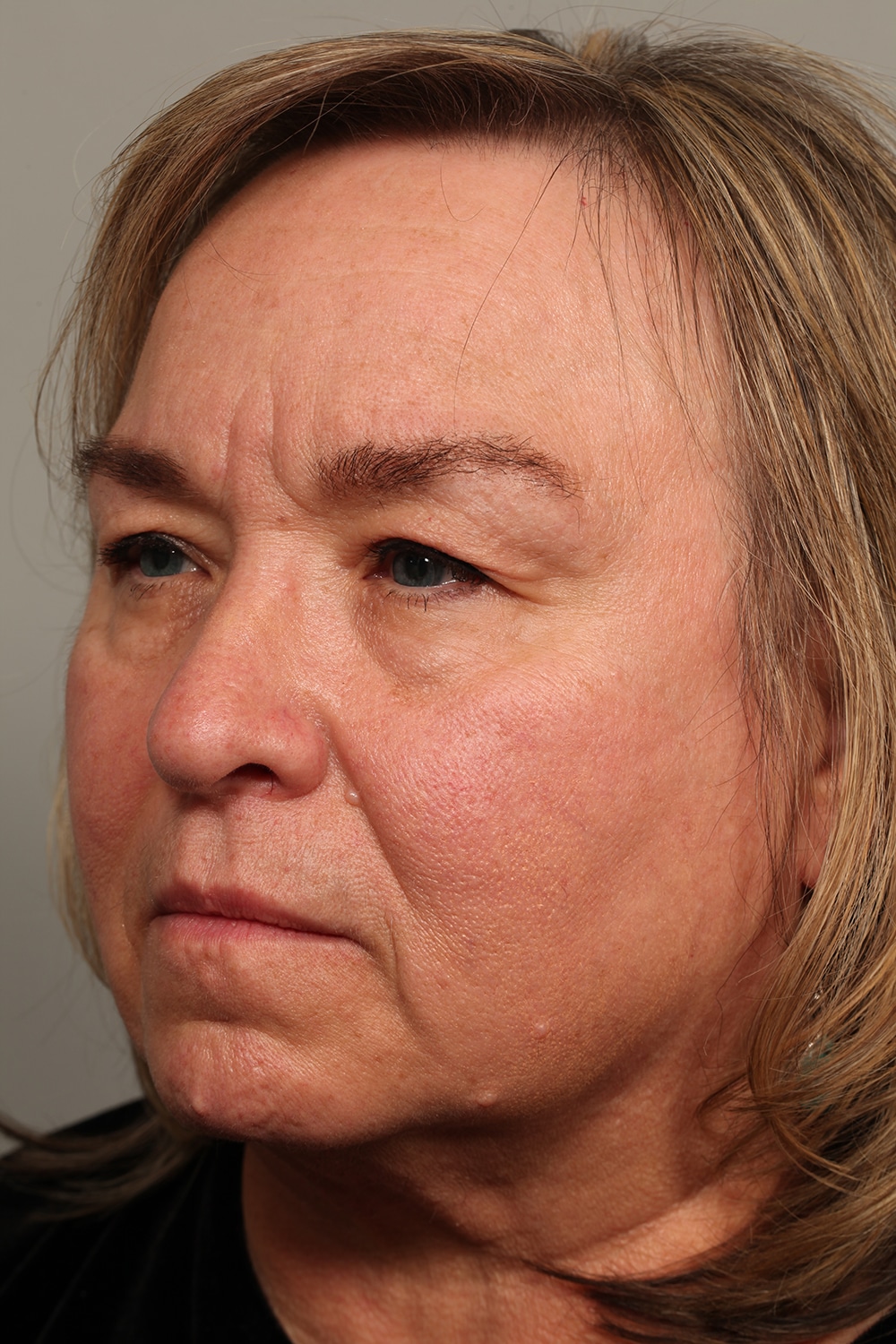 Before Image: Upper and lower lid blepharoplasty with laser resurfacing to the lower lids - front