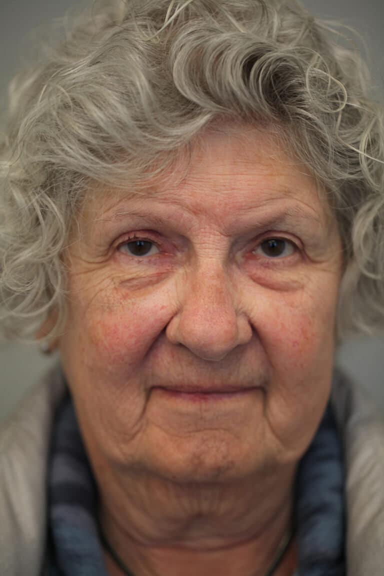 After Image: Upper Blepharoplasty and Ptosis Repair - front