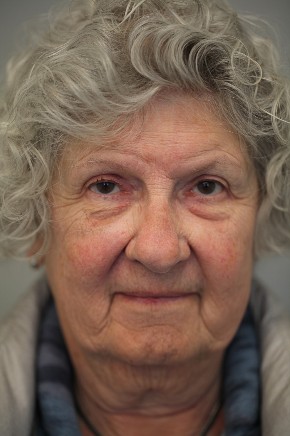 After Image: Upper Blepharoplasty and Ptosis Repair - front