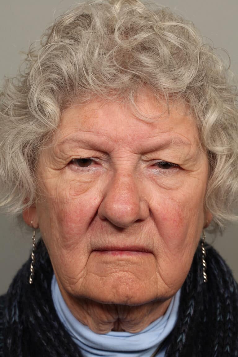 Before Image: Upper Blepharoplasty and Ptosis Repair - front