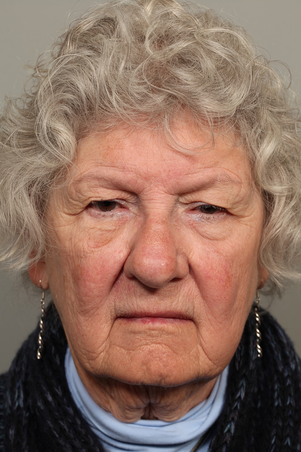 Before Image: Upper Blepharoplasty and Ptosis Repair - front