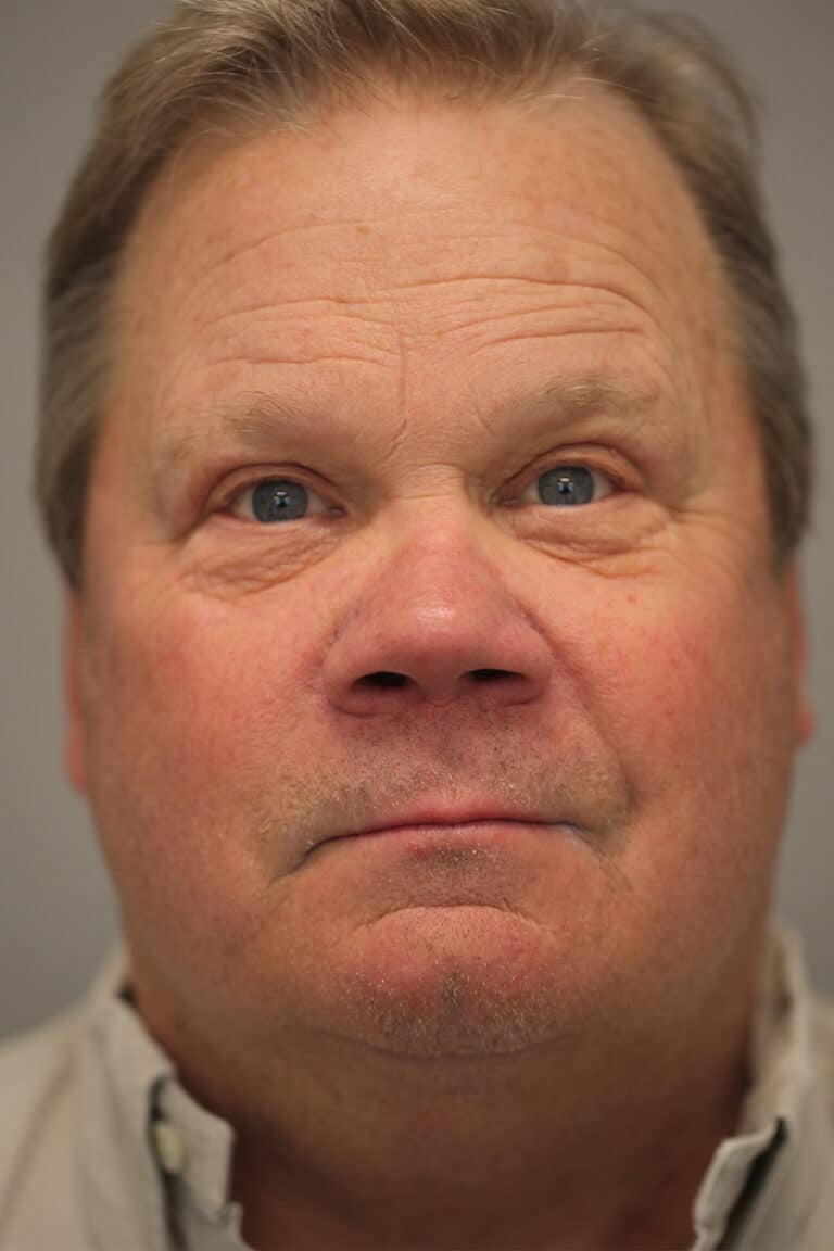 After Image: Upper Blepharoplasty - front