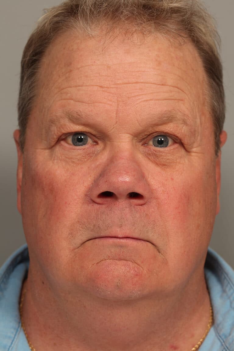 Before Image: Upper Blepharoplasty - front