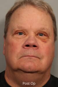 After Image: Upper Blepharoplasty