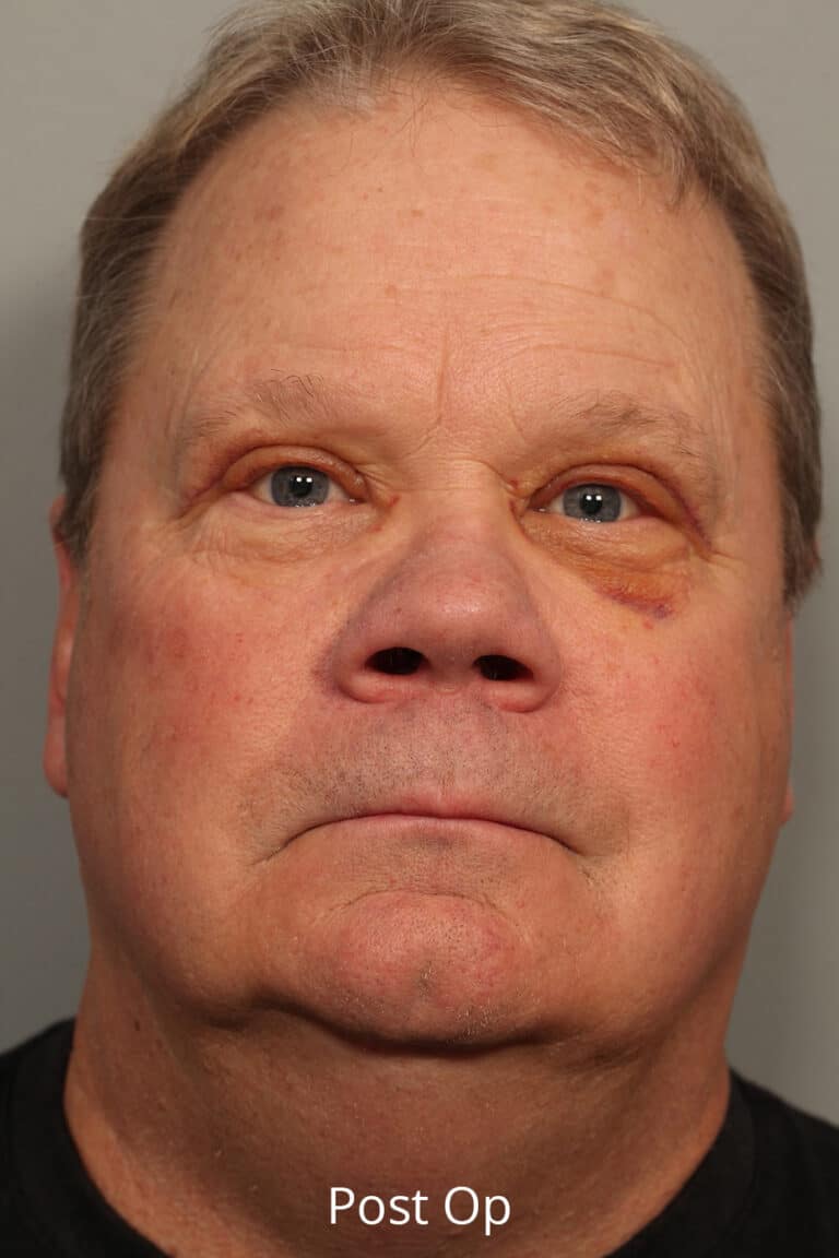 After Image: Upper Blepharoplasty - front