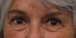 Upper Blepharoplasty
