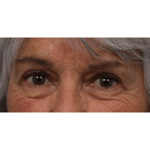 Upper Blepharoplasty