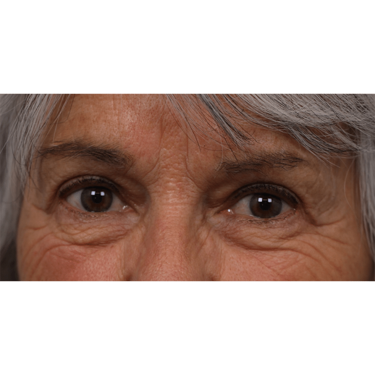 After Image: Upper Blepharoplasty - front