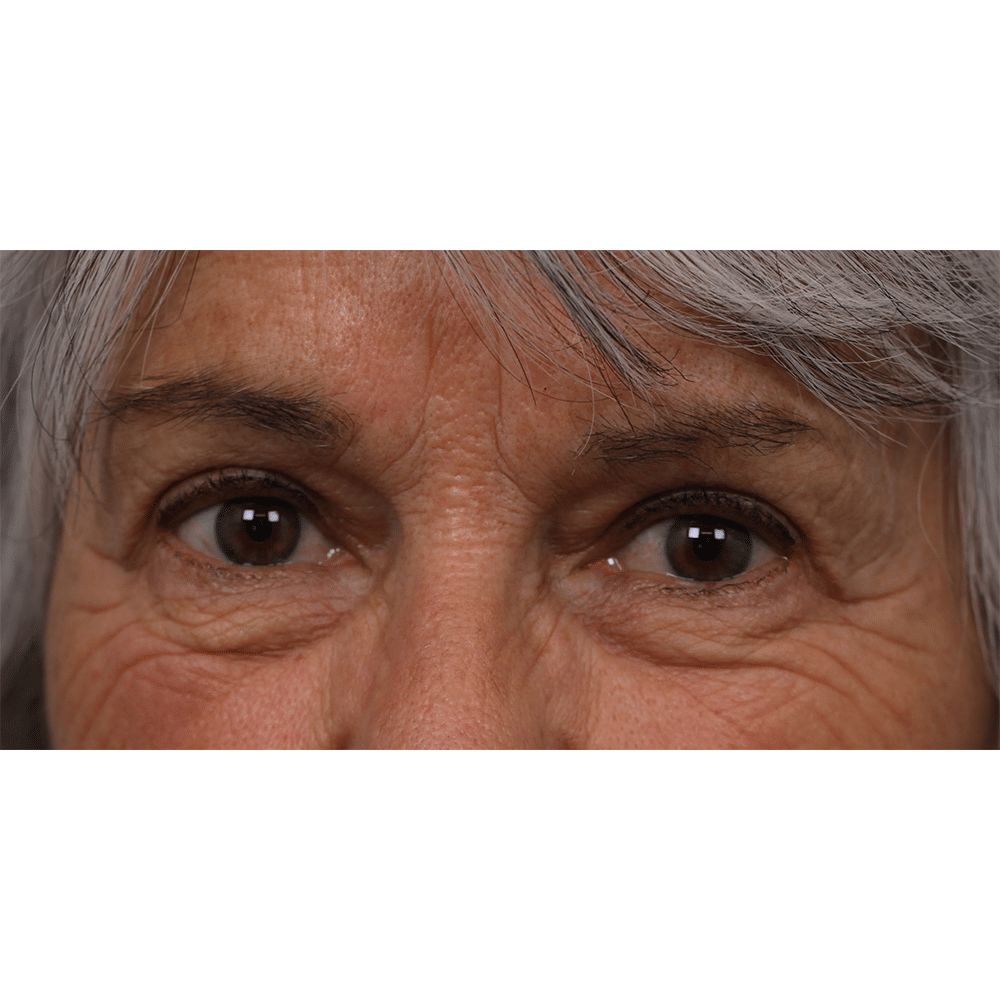 After Image: Upper Blepharoplasty - front