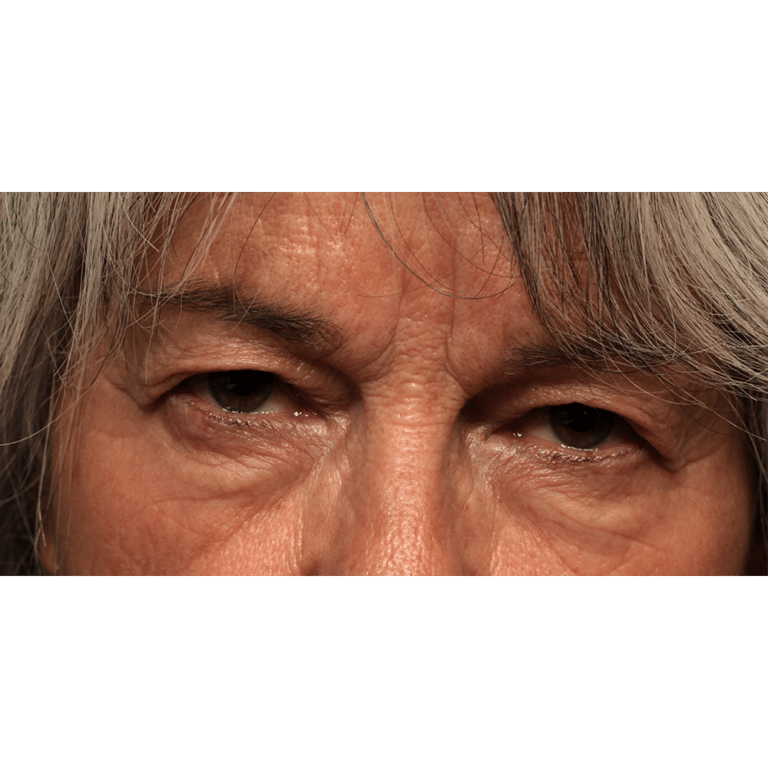 Before Image: Upper Blepharoplasty - front