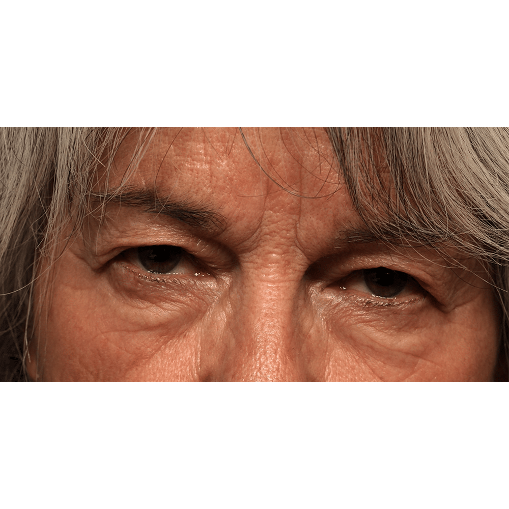 Before Image: Upper Blepharoplasty - front