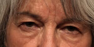 Upper Blepharoplasty