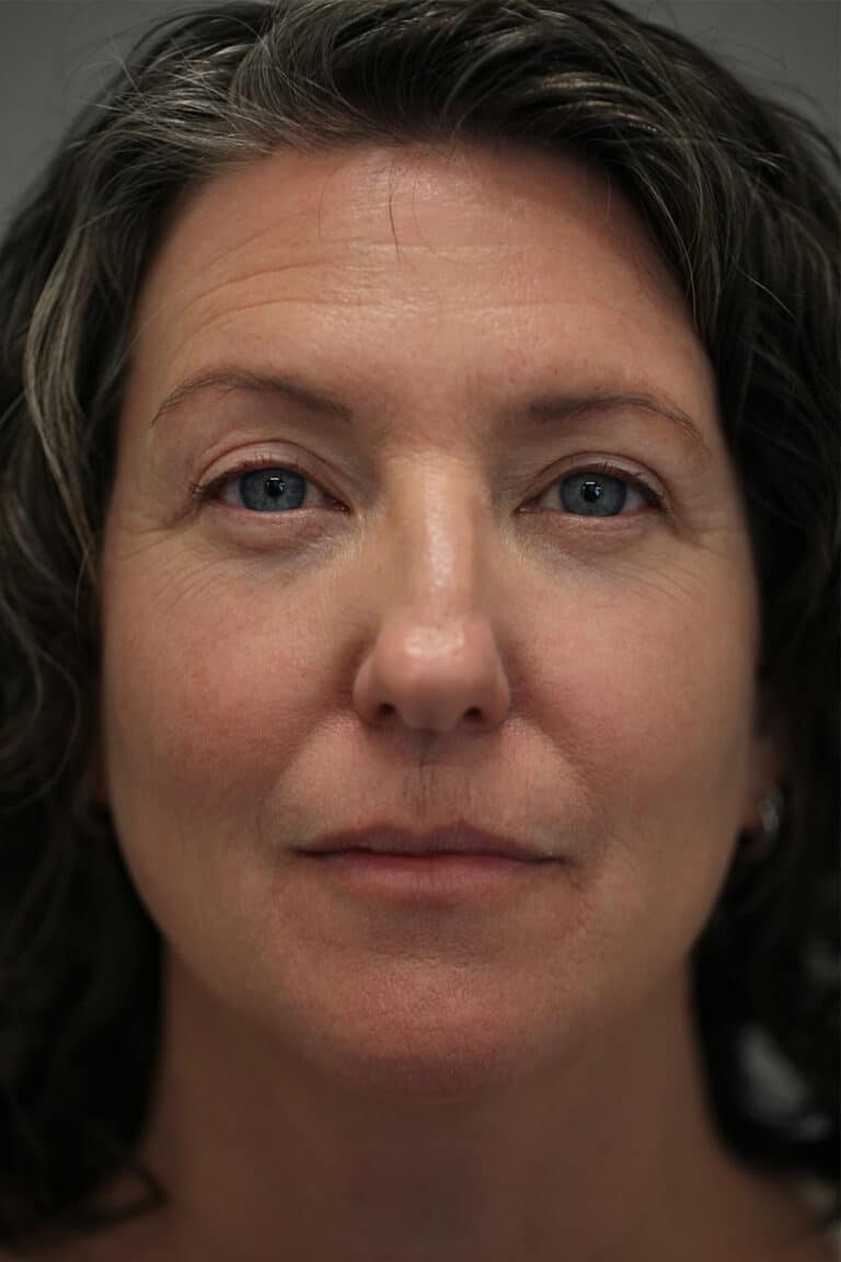 After Image: Upper Blepharoplasty - front