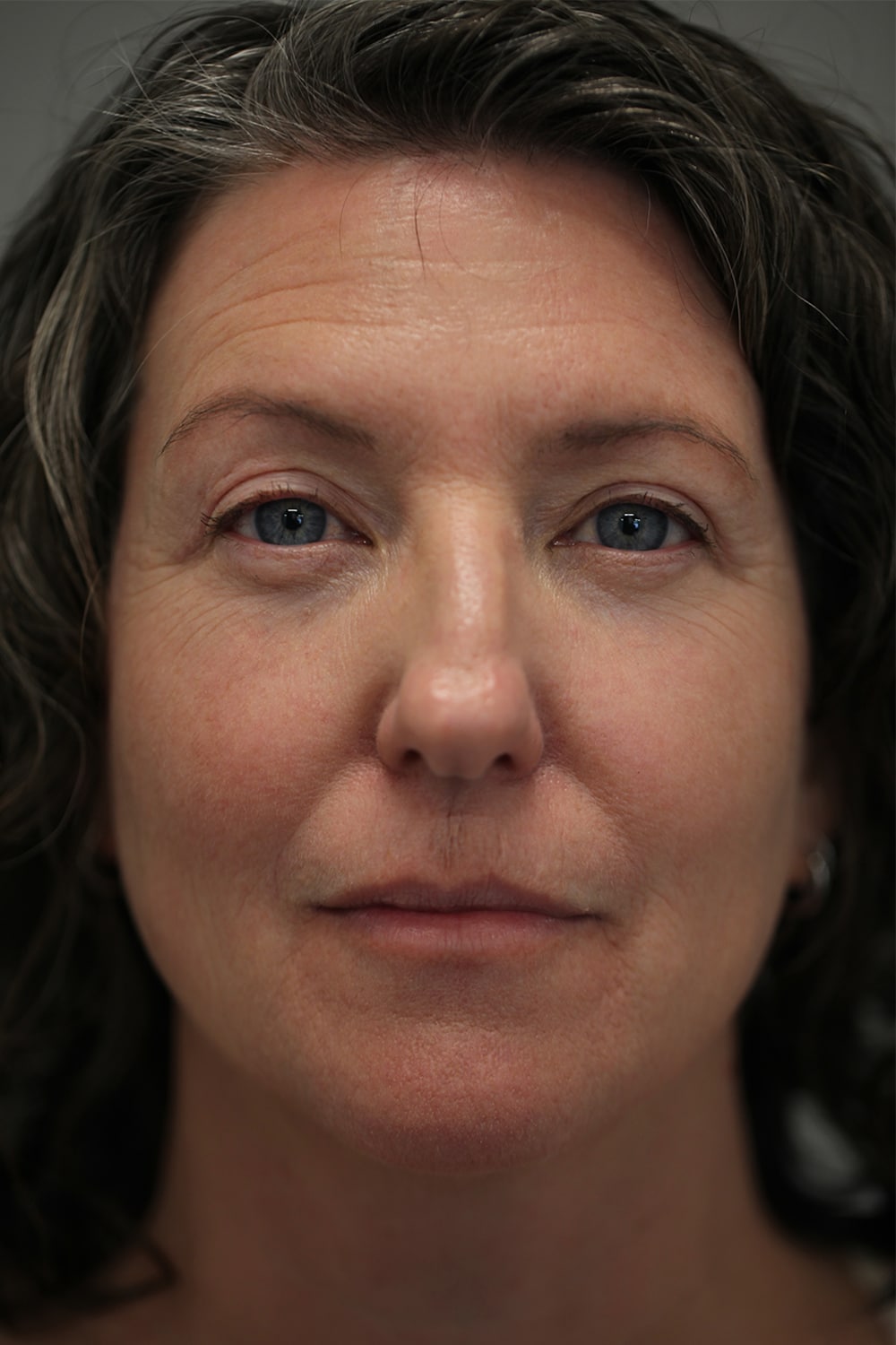 After Image: Upper Blepharoplasty - front