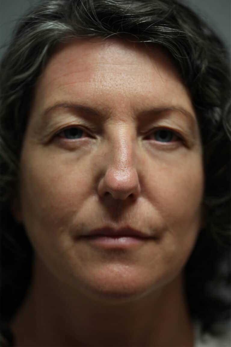 Before Image: Upper Blepharoplasty - front