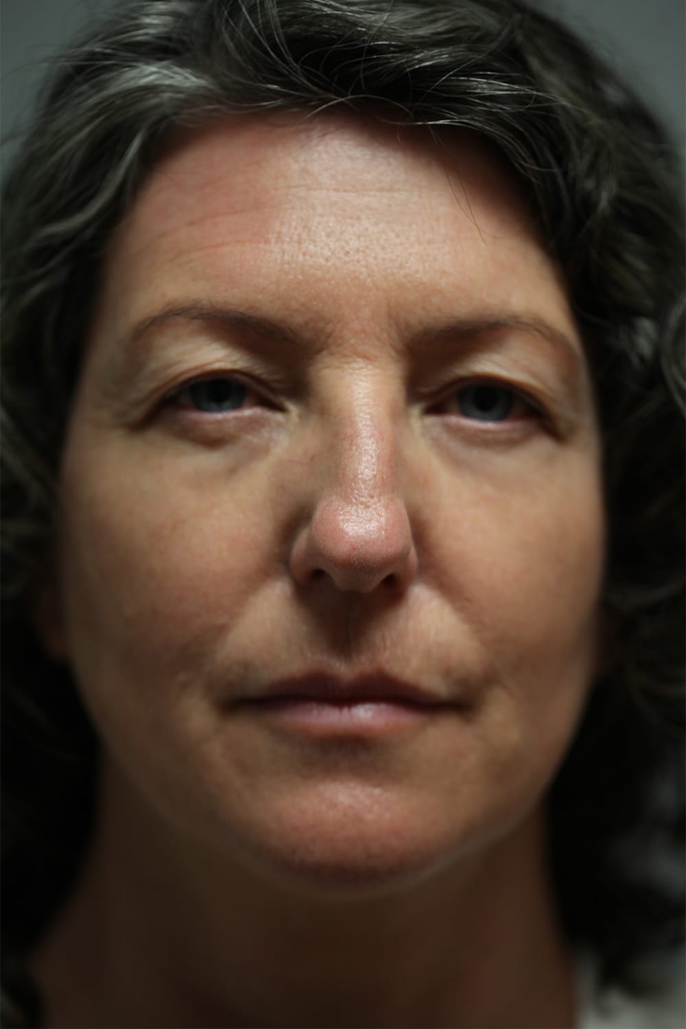 Before Image: Upper Blepharoplasty - front